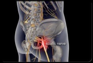 Denas Sciatica