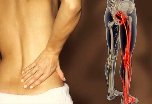 Denas Sciatica