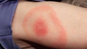 Sedona Lymes Disease